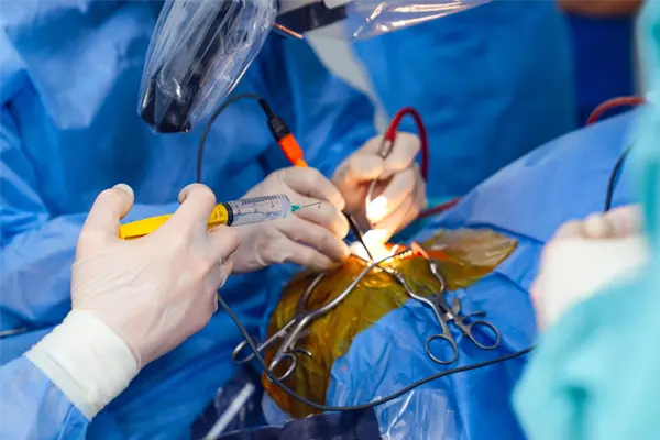 Understanding ACL Reconstruction Surgery: Procedure, Benefits, and Recovery