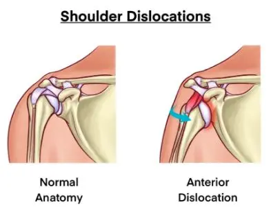 Types of Shoulder Dislocation