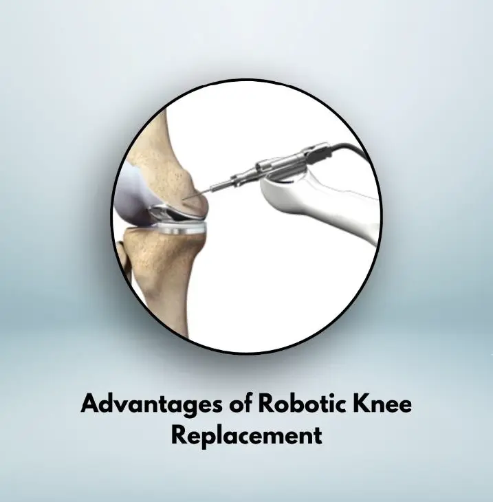 Advantages of Robotic Knee Replacement