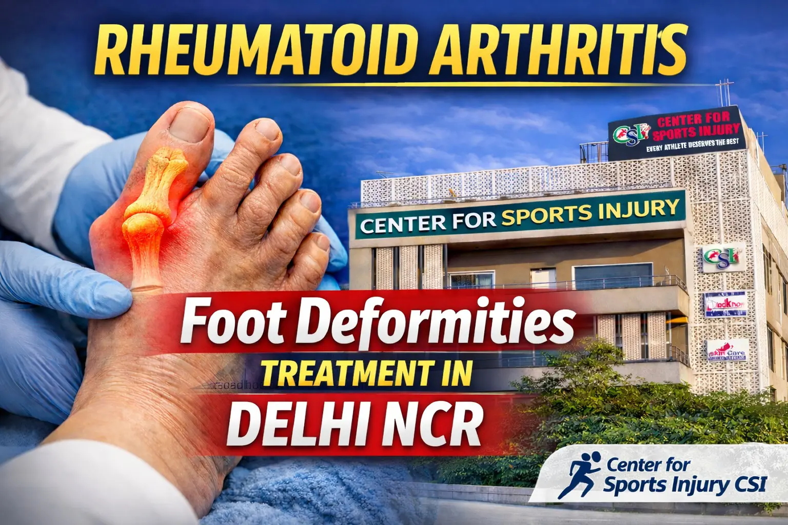 Rheumatoid Arthritis Foot Deformities: Causes, Symptoms, and Treatment Options