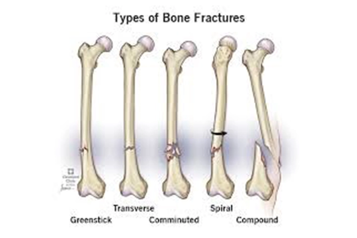 MIS Hip Replacement Surgery