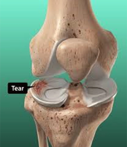 Meniscus Tear Repair Surgery