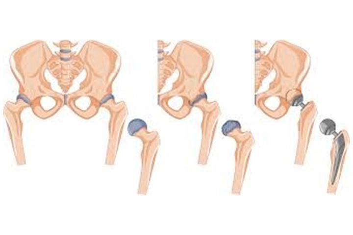 MIS Hip Replacement Surgery