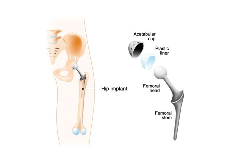 MIS Hip Replacement Surgery