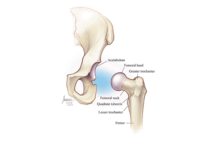 MIS Hip Replacement Surgery