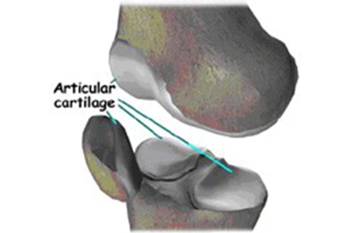 MIS Knee Replacement Surgery