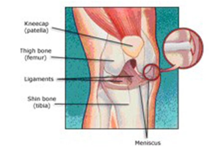 MIS Knee Replacement Surgery