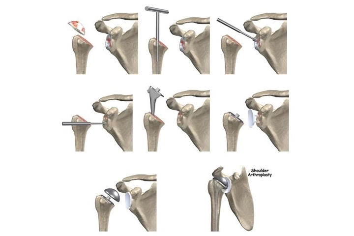 Knee Arthroscopy & ACL Surgery